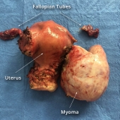 19-1030 Removed Mayoma, Uterus, Follopian TubesA